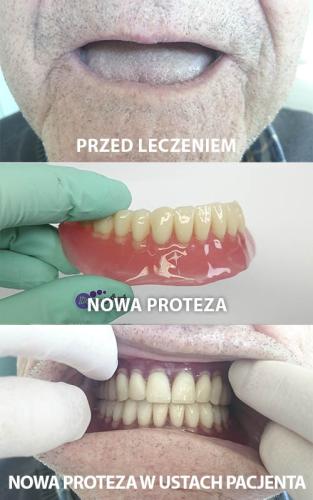 PACJENT 10A - 66 LAT