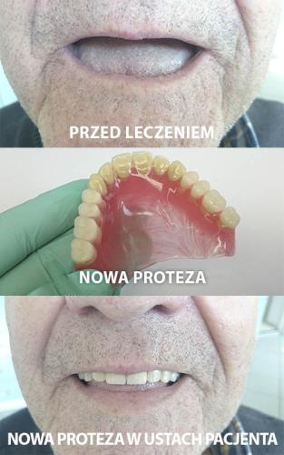 PACJENT 10B - 66 LAT